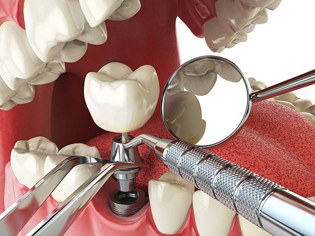 Best Emergency Dentist for Lost Fillings or Crowns in Fruitridge Pocket, CA